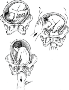 Technique For Classical CS Rural Surgery Obstetrics technique-for-classical-cs-rural-surgery-obstetrics