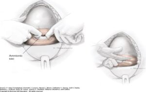 CS – Uterine Incision – Rural Surgery & Obstetrics